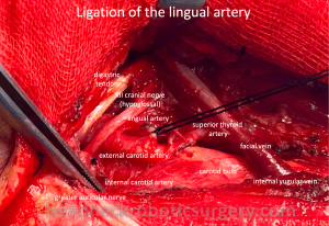 Management of the lingual artery in TORS – Head and Neck Robotic Surgery