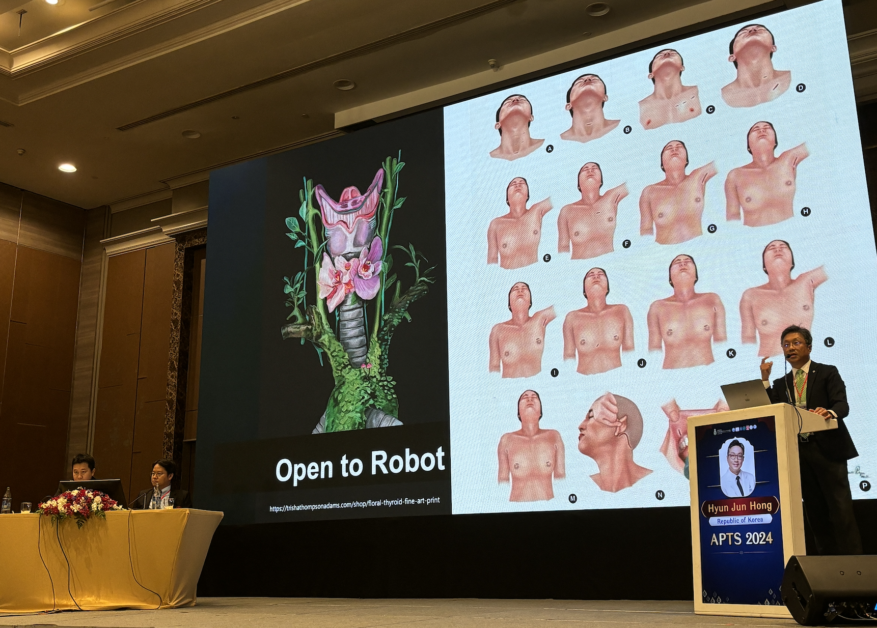 Retroauricular Approach Highlights from APTS 2024, Bangkok – Head and Neck Robotic Surgery